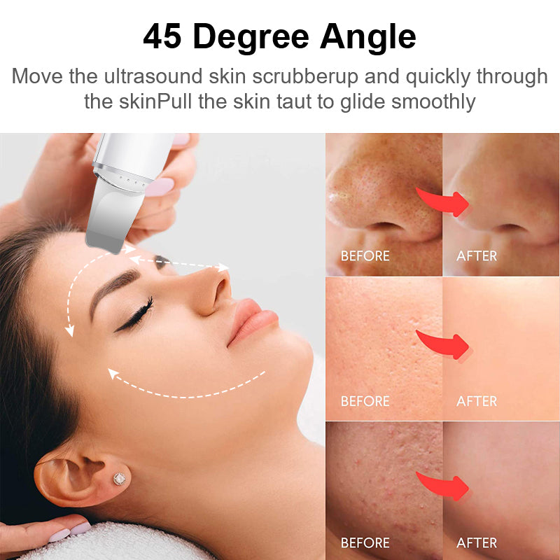 Ultrasonic skin scrubber vibration face blackhead remover for deep cleansing, designed to remove blackheads, dirt, and oil while exfoliating and rejuvenating the skin.