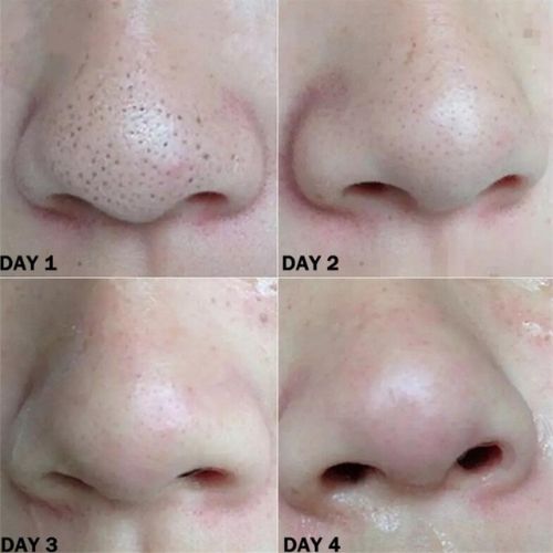 25x nose blackhead remover strips for deep cleansing, designed to unclog pores and remove blackheads, leaving your skin smooth, clear, and refreshed.