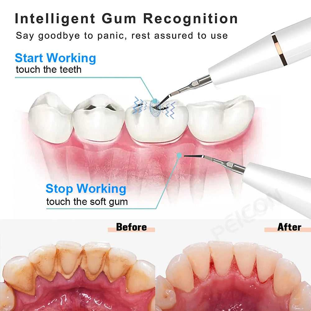 Ultrasonic dental teeth plaque remover and cleaner for a professional clean, designed to remove plaque, tartar, and stains while promoting healthier teeth and gums.